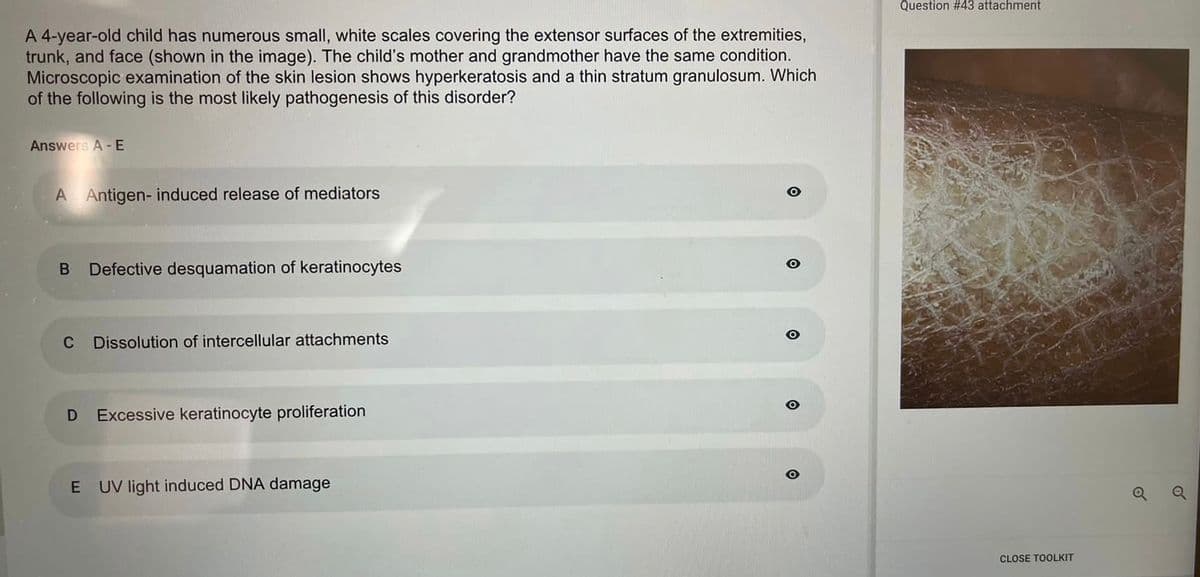 A 4-year-old child has numerous small, white scales covering the extensor surfaces of the extremities,
trunk, and face (shown in the image). The child's mother and grandmother have the same condition.
Microscopic examination of the skin lesion shows hyperkeratosis and a thin stratum granulosum. Which
of the following is the most likely pathogenesis of this disorder?
Answers A-E
A Antigen- induced release of mediators
B Defective desquamation of keratinocytes
C Dissolution of intercellular attachments
D Excessive keratinocyte proliferation
E UV light induced DNA damage
O
O
O
Question #43 attachment
CLOSE TOOLKIT