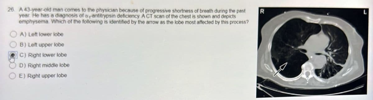 26 A 43-year-old man comes to the physician because of progressive shortness of breath during the past
year. He has a diagnosis of a,antitrypsin deficiency. A CT scan of the chest is shown and depicts
emphysema. Which of the following is identified by the arrow as the lobe most affected by this process?
A) Left lower lobe
B) Left upper lobe
C) Right lower lobe
D) Right middle lobe
E) Right upper lobe
70
R
Q