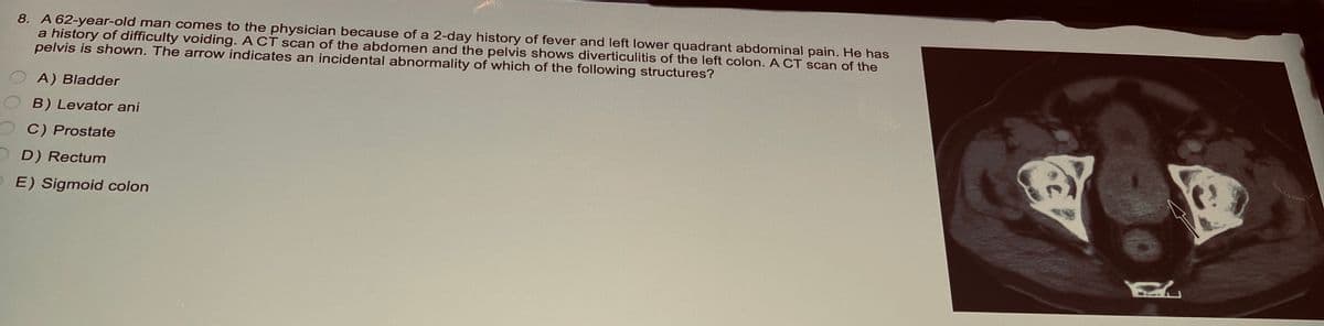 8. A 62-year-old man comes to the physician because of a 2-day history of fever and left lower quadrant abdominal pain. He has
a history of difficulty voiding. A CT scan of the abdomen and the pelvis shows diverticulitis of the left colon. A CT scan of the
pelvis is shown. The arrow indicates an incidental abnormality of which of the following structures?
A) Bladder
B) Levator ani
OC) Prostate
OD) Rectum
E) Sigmoid colon
EX