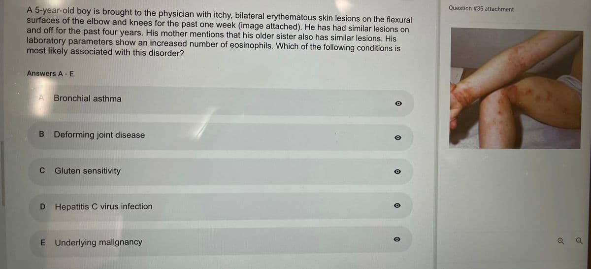 A 5-year-old boy is brought to the physician with itchy, bilateral erythematous skin lesions on the flexural
surfaces of the elbow and knees for the past one week (image attached). He has had similar lesions on
and off for the past four years. His mother mentions that his older sister also has similar lesions. His
laboratory parameters show an increased number of eosinophils. Which of the following conditions is
most likely associated with this disorder?
Answers A - E
A Bronchial asthma
B Deforming joint disease
C Gluten sensitivity
D Hepatitis C virus infection
E Underlying malignancy
O
O
Question # 35 attachment