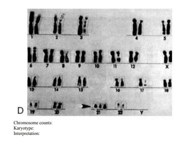 10 11 12
11
16
17
16
D
Chromosome counts:
Karyotype:
Interpretation:
