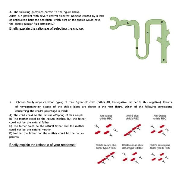 4. The following questions pertain to the figure above.
Adam is a patient with severe central diabetes insipidus caused by a lack
of antidiuretic hormone secretion, which part of the tubule would have
the lowest tubular fluid osmolarity?
Briefly explain the rationale of selecting the choice:
5.
Johnson family requests blood typing of their 2-year-old child (father AB, Rh-negative; mother B, Rh negative). Results
of hemagglutination assays of the child's blood are shown in the next figure. Which of the following conclusions
concerning the child's parentage is valid?
A) The child could be the natural offspring of this couple
B) The mother could be the natural mother, but the father
could not be the natural father
ก
C) The father could be the natural father, but the mother
could not be the natural mother
D) Neither the father nor the mother could be the natural
parents
Briefly explain the rationale of your response:
Anti-A plus
child's RBC
Child's serum plus
donor type A RBC
Anti-B plus
child's RBC
Child's serum plus
donor type B RBC
Anti-D plus
child's RBC
Child's serum plus
donor type D RBC