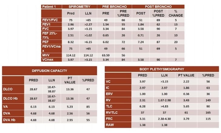 Patient 1
SPIROMETRY
PRE BRONCHO
POST BRONCHO
PRE
POST
Pred
LLN
PRE
POST
%PRED
%PRED CHANGE
FEV1/FVC
75
>65
49
66
51
69
5
FEV1
2.96
>2.27
1.54
55
1.84
62
13
FVC
3.97
>3.15
3.34
84
3.58
90
7
FEF 25%-
2.51
>1.02
0.65
26
0.71
26
10
75%
PEF
8.32
>6.15
6.02
72
7.24
87
20
FEV1NCma
75
>65
49
66
51
69
X
MVV
VCmax
114.12
114.12
63.59
56
3.97
>3.15
3.34
84
3.58
90
BODY PLETHYSMOGRAPHY
DIFFUSION CAPACITY
PRED
LLN
PT VALUE
%PRED
PT
PRED
LLN
%PRED
VALUE
VC
3.97
>3.15
2.22
56
18.47-
IC
2.97
2.97
1.86
63
DLCO
28.67
13.36
47
38.87
ERV
1.00
1.00
0.36
36
DLCO Hb
18.47-
28.67
13.36
47
38.87
RV
2.31
1.67-2.98
3.43
149
VA
DVA
6.13
6.13
5.23
85
TLC
6.28
>4.83
5.65
90
4.68
4.68
2.56
56
RVITLC
37
37
61
165
DVA Hb
FRC
3.31
2.38-4.30
3.79
115
4.68
4.68
2.55
55
RAW
1.38
1.38
