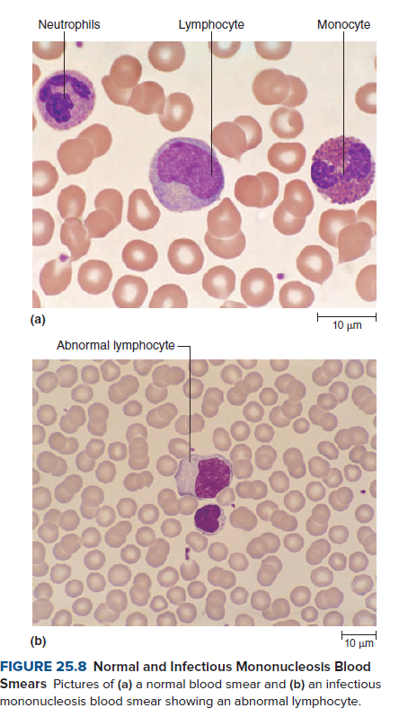 Neutrophils
Lymphocyte
Monocyte
(a)
10 um
Abnormal lymphocyte -
(b)
10 um
FIGURE 25.8 Normal and Infectious Mononucleosis Blood
Smears Pictures of (a) a normal blood smear and (b) an infectious
mononucleosis blood smear showing an abnormal lymphocyte.
