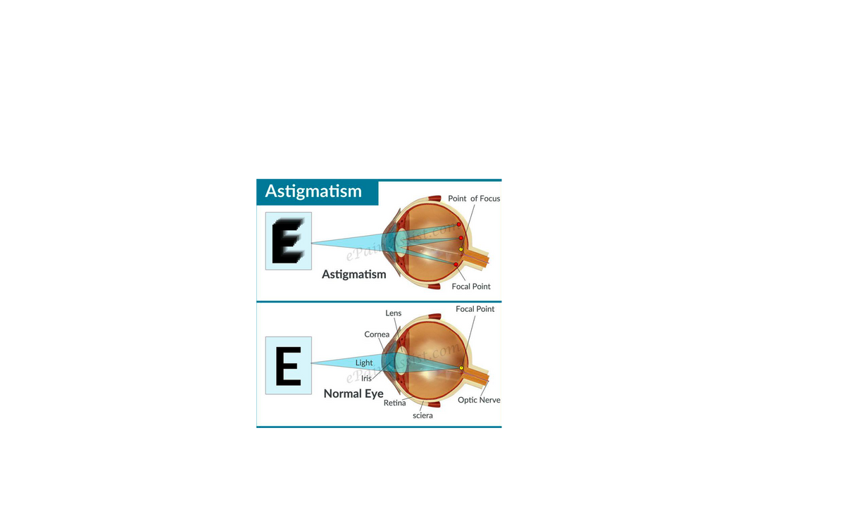 Astigmatism
Point of Focus
ePaisst.com
Astigmatism
Focal Point
Lens
Focal Point
Cornea
Light
St.com
ePiris
Normal Eye
Retina
Optic Nerve
sciera
E
