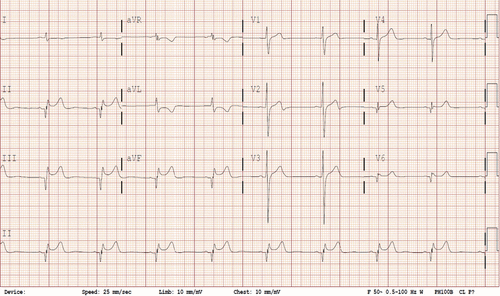 II
v2
III
II
Speed: 25 m/sec
Linb: 10 m/
Chest: 10 mm/
r S0- 0.5-100 E
Derice:
