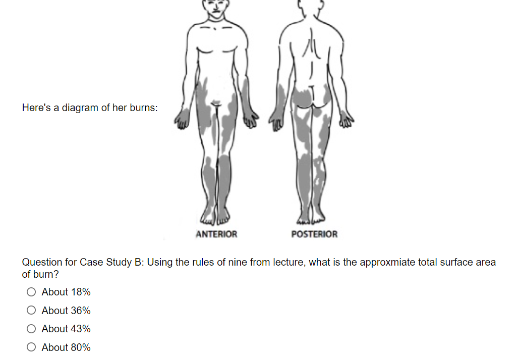 Here's a diagram of her burns:
ANTERIOR
POSTERIOR
Question for Case Study B: Using the rules of nine from lecture, what is the approxmiate total surface area
of burn?
O About 18%
O About 36%
O About 43%
O About 80%