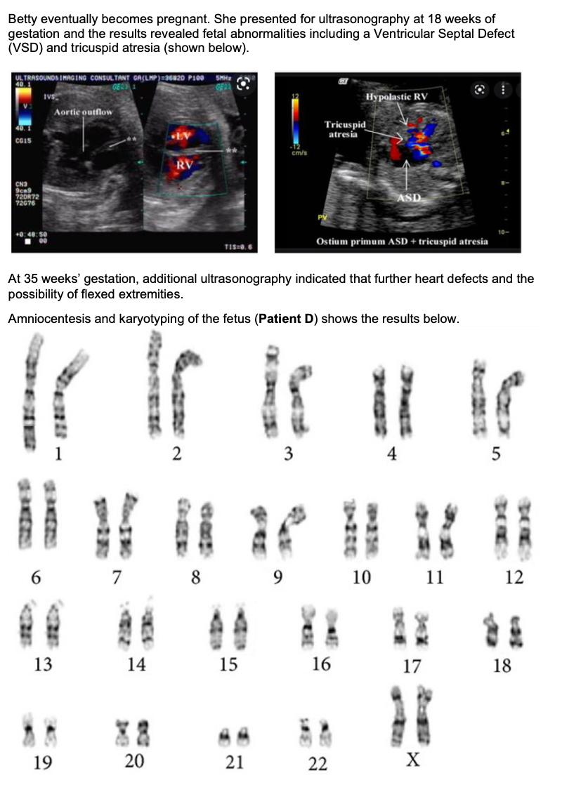 Betty eventually becomes pregnant. She presented for ultrasonography at 18 weeks of
gestation and the results revealed fetal abnormalities including a Ventricular Septal Defect
(VSD) and tricuspid atresia (shown below).
ULTRASOUNDS IMAGING CONSULTANT GA(LMP)=36820 P100 SMHz
GER
40
40.1
CG15
CN3
9cm9
220822
72076
IVS
+0:48:50
00
Aortic outflow
13
19
EV
RV
20
2
7 8
TIS=0.6
At 35 weeks' gestation, additional ultrasonography indicated that further heart defects and the
possibility of flexed extremities.
Amniocentesis and karyotyping of the fetus (Patient D) shows the results below.
cm/s
21
3
9
Hypolastic RV
Tricuspid
atresia
ASD
Ostium primum ASD + tricuspid atresia
14 15 16 17
10 11 12
5
22 X
200
18