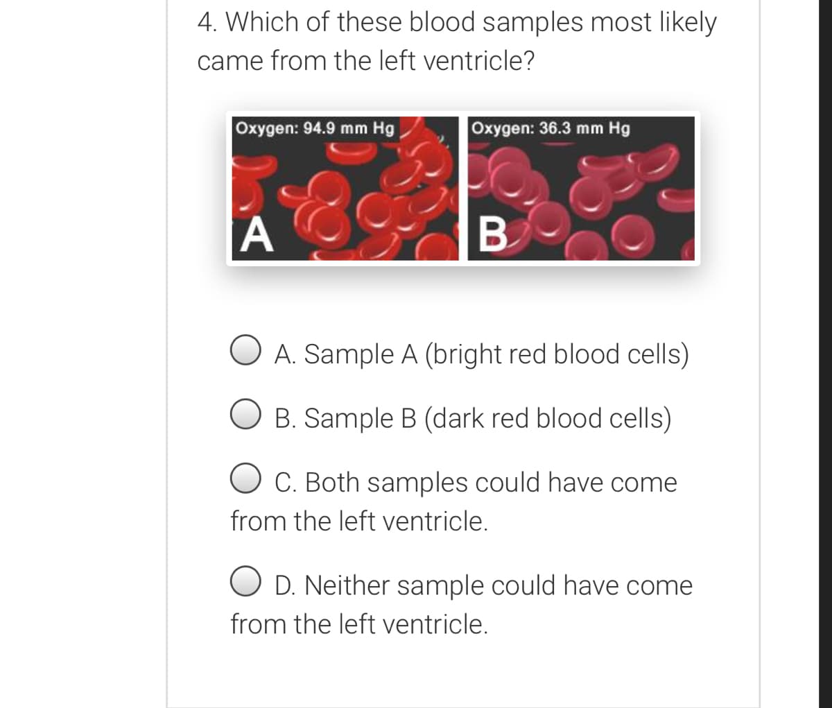 4. Which of these blood samples most likely
came from the left ventricle?
Oxygen: 94.9 mm Hg
Oxygen: 36.3 mm Hg
B.
O A. Sample A (bright red blood cells)
B. Sample B (dark red blood cells)
O C. Both samples could have come
from the left ventricle.
O D. Neither sample could have come
from the left ventricle.
