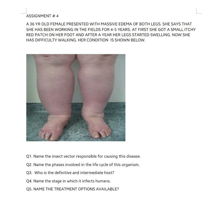 ASSIGNMENT # 4
A 36 YR OLD FEMALE PRESENTED WITH MASSIVE EDEMA OF BOTH LEGS. SHE SAYS THAT
SHE HAS BEEN WORKING IN THE FIELDS FOR 4-5 YEARS. AT FIRST SHE GOT A SMALL ITCHY
RED PATCH ON HER FOOT AND AFTERA YEAR HER LEGS STARTED SWELLING. NOW SHE
HAS DIFFICULTY WALKING. HER CONDITION IS SHOWN BELOW.
Q1. Name the insect vector responsible for causing this disease.
Q2. Name the phases involved in the life cycle of this organism.
Q3. Who is the definitive and intermediate host?
Q4. Name the stage in which it infects humans.
Q5. NAME THE TREATMENT OPTIONS AVAILABLE?
