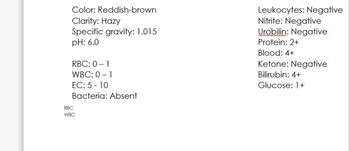 Color: Reddish-brown
Clarity: Hazy
Specific gravity: 1.015
pH: 6.0
Leukocytes: Negative
Nitrite: Negative
Urobilin: Negative
Protein: 2+
Blood: 4+
RBC: 0 - 1
Ketone: Negative
WBC: 0 - 1
Bilirubin: 4+
EC: 5 - 10
Glucose: 1+
Bacteria: Absent
RBC
WBC
