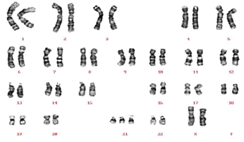 **Human Karyotype Diagram**

**Description:**

This image is a visual representation of a human karyotype, which displays the chromosomes present in a diploid cell. Karyotypes are used in genetics and cytogenetics for visualizing the structure, number, and abnormalities of chromosomes. 

**Details:**

1. **Chromosomes Arrangement:**
   - The chromosomes are arranged in 23 pairs, labeled from 1 to 22 followed by sex chromosomes (X and Y).
   - Each pair consists of two chromosomes, one inherited from each parent.

2. **Identification:**
   - The chromosomes are identified and numbered based on their size, banding pattern, and centromere position.
   - Pair 1 is the largest, and pair 22 is the smallest. The size and banding patterns help in distinguishing each pair.

3. **Sex Chromosomes:**
   - The last two chromosomes shown are the sex chromosomes. In this diagram, they are labeled as X and Y.
   - The presence of both X and Y indicates a male karyotype. Females would have two X chromosomes (XX).

**Educational Importance:**

- **Genetic Analysis:** Karyotyping is crucial for:
  - Diagnosing genetic disorders (e.g., Down syndrome, Turner syndrome).
  - Understanding chromosomal abnormalities (e.g., translocations, deletions).
  - Conducting genetic research.

- **Medical Diagnosis:** Used in prenatal screening, cancer diagnosis to detect chromosomal changes in tumor cells, and infertility testing.

**Visualization Techniques:**

- The chromosomes are stained with specific dyes (e.g., Giemsa stain) to produce a banding pattern unique to each chromosome. This banding is critical for identifying structural features and abnormalities.

**Interpretation:**

- **Banding Patterns:** Dark and light bands represent the areas rich in Adenine-Thymine (A-T) and Guanine-Cytosine (G-C) base pairs.
- **Abnormalities Identification:** By comparing normal karyotypes to patient's karyotypes, abnormalities can be pinpointed, aiding in diagnosis and research.

This diagram is an essential tool in genetics and provides foundational knowledge for understanding human heredity and genetic variations.