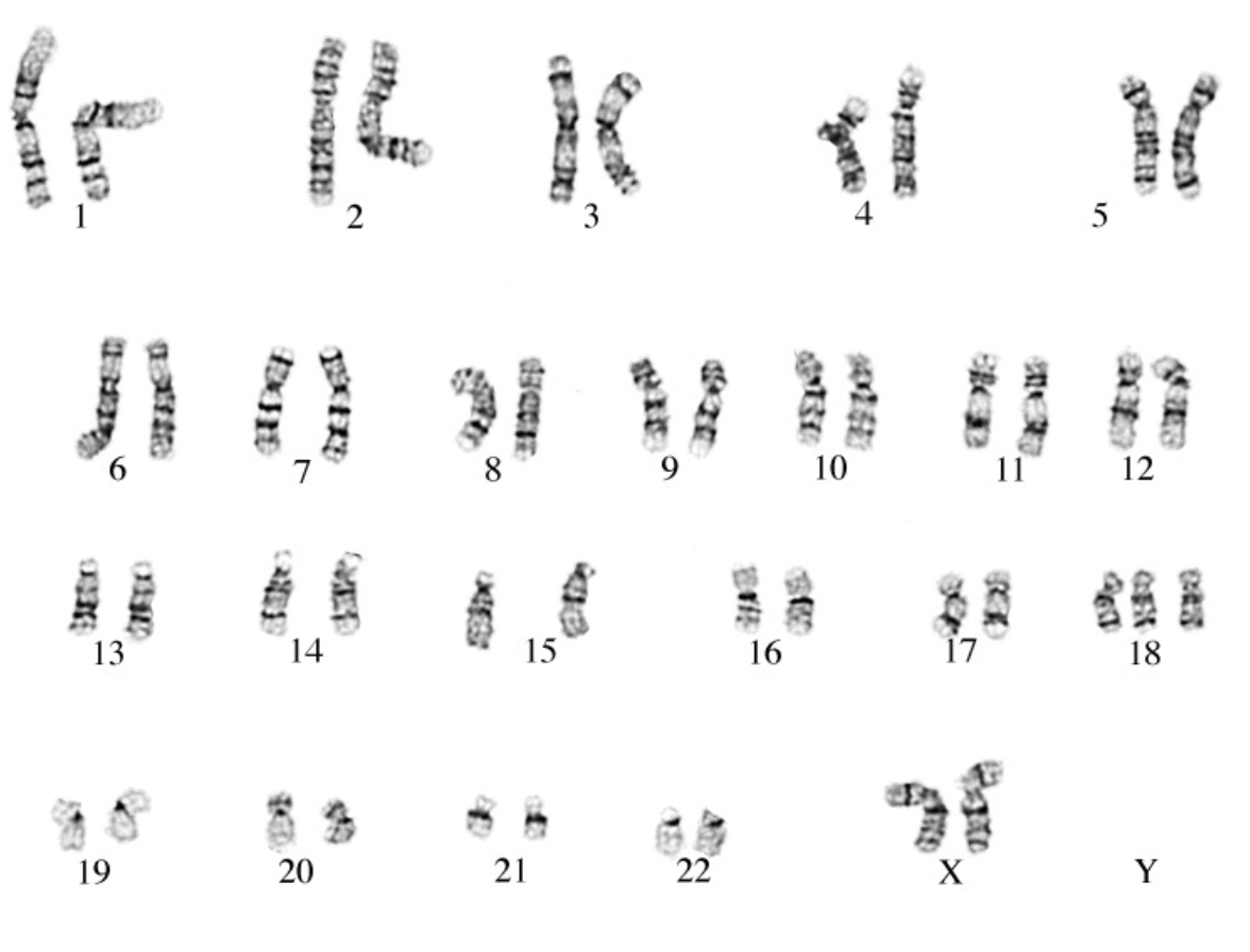 ### Human Karyotype

A karyotype is an organized profile of an individual's chromosomes. Chromosomes are structures within cells that contain a person's genes. Here, we present a typical human karyotype showcasing 23 pairs of chromosomes arranged and numbered by size from 1 to 22, with the 23rd pair being the sex chromosomes (X and Y).

1. **Chromosome Pair 1**: The largest and is typically found to be well-banded.
2. **Chromosome Pair 2**: Slightly smaller than pair 1 with distinct banding patterns.
3. **Chromosome Pair 3**: Similar in size to chromosome pair 2.
4. **Chromosome Pair 4**: Noticeably smaller than pair 3.
5. **Chromosome Pair 5**: Smaller than pair 4, with defining band patterns.
6. **Chromosome Pair 6**: Similar in size to pair 5 but different in banding.
7. **Chromosome Pair 7**: Displays unique bands distinct from pair 6.
8. **Chromosome Pair 8**: Similar in size to pair 7, showing clear banding.
9. **Chromosome Pair 9**: Noticeable for its strong band patterns.
10. **Chromosome Pair 10**: Slightly smaller, with distinct bands.
11. **Chromosome Pair 11**: Smaller size but clear band distinctions.
12. **Chromosome Pair 12**: Comparable in size to pair 11.
13. **Chromosome Pair 13**: Noticeably smaller, with broad bands at the ends.
14. **Chromosome Pair 14**: Slightly smaller than pair 13, clear bands are present.
15. **Chromosome Pair 15**: Similar to pair 14 in size and banding patterns.
16. **Chromosome Pair 16**: Shows a smaller profile and different banding.
17. **Chromosome Pair 17**: Slightly larger in comparison to pair 16.
18. **Chromosome Pair 18**: A distinct small chromosome pair.
19. **Chromosome Pair 19**: Among the smaller chromosomes, well-banded.
20. **Chromosome Pair 20**: Similar to pair 19 in terms of size.
21. **Chromosome Pair 21**: Significantly smaller, with light banding.
22. **Chromosome Pair 