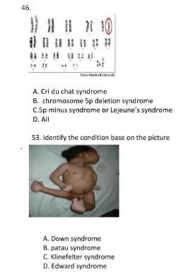 46.
Ioko dedod Uesty
A. Cri du chat syndrome
B. chromosome 5p deletion syndrome
C.5p minus syndrome or Lejeune's syndrome
D. All
53. Identify the condition base on the picture
A. Down syndrome
B. patau syndrome
C. Klinefelter syndrome
D. Edward syndrome
