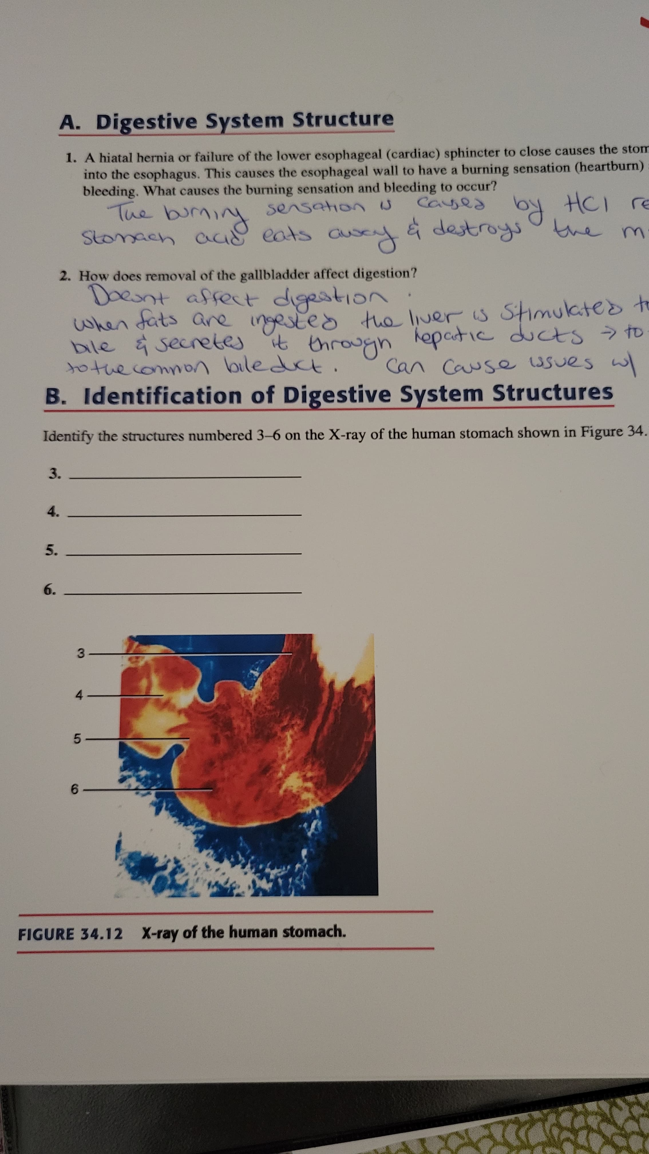 A. Digestive System Structure
1. A hiatal hernia or failure of the lower esophageal (cardiac) sphincter to close causes the stom
into the esophagus. This causes the esophageal wall to have a burning sensation (heartburn)
bleeding. What causes the burning sensation and bleeding to occur?
sensationN
ざiwa
eats a
à destroys
JつH Ro eons
Stomach ac
the m.
2. How does removal of the gallbladder affect digestion?
Doesnt affect
when dats are the liver s Stimukteoto
bile & secretes it throun
tothecommon bileduc
B. Identification of Digestive System Structures
digestion
लभु पलाल
ingested
hepatic ducts to
Can Cause ssues w
Identify the structures numbered 3-6 on the X-ray of the human stomach shown in Figure 34.
3.
4.
5.
6.
3.
4.
5.
FIGURE 34.12 X-ray of the human stomach.
