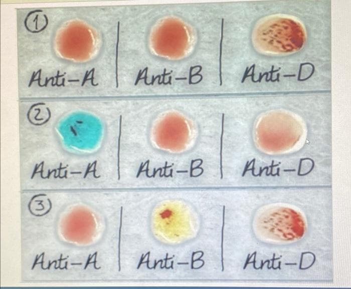 Anti-A
Anti-B
Anti-D
2)
Anti-A
Anti-B
Anti-D
Anti-A
Anti-B
Anti-D
