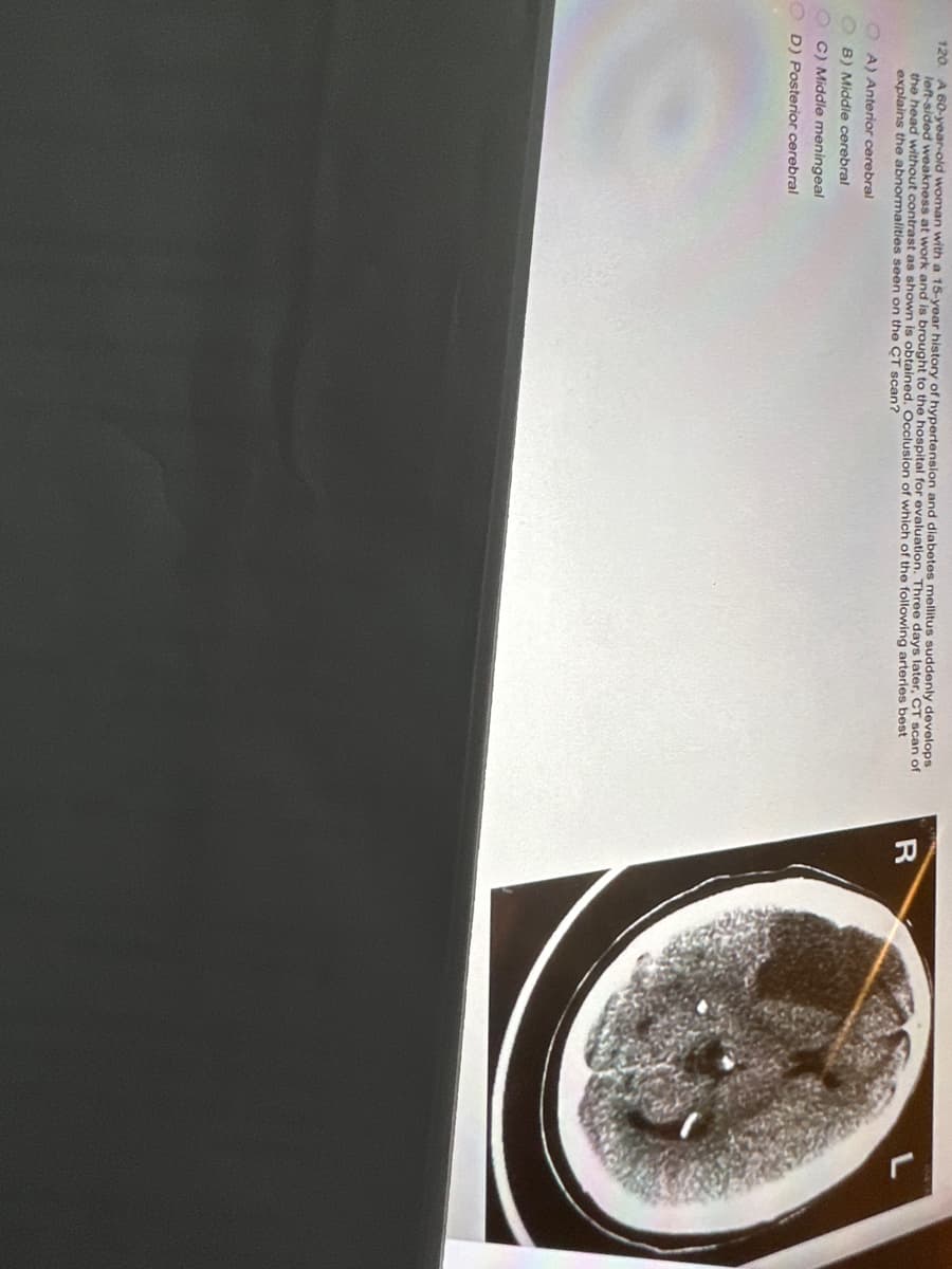 120 A 60-year-old woman with a 15-year history of hypertension and diabetes mellitus suddenly develops
left-sided weakness at work and is brought to the hospital for evaluation. Three days later, CT scan of
the head without contrast as shown is obtained. Occlusion of which of the following arteries best
explains the abnormalities seen on the CT scan?
OA) Anterior cerebral
B) Middle cerebral
C) Middle meningeal
OD) Posterior cerebral
R
L