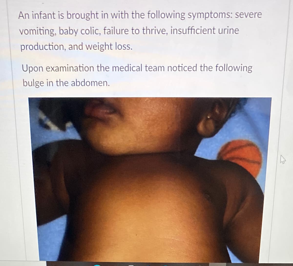 An infant is brought in with the following symptoms: severe
vomiting, baby colic, failure to thrive, insufficient urine
production, and weight loss.
Upon examination the medical team noticed the following
bulge in the abdomen.
