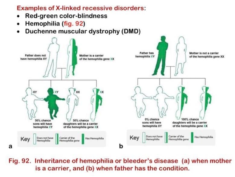 Examples of X-linked recessive disorders:
• Red-green color-blindness
• Hemophilia (fig. 92)
• Duchenne muscular dystrophy (DMD)
Father has
Mother is not a carrier
Father does not
have hemophilla XY
Mother is a carrier
of the hemophila gene X
of the hemophilia gene XX
hemophila XY
100% chance
daughters will be a carrier
of the hemophila gene XX
s0% chance
s0% chance
daughters will be a carrier
of the hemophilla gene XX
0% chance
sons will have
hemophilia XY
sons will have
hemophila XY
Does not have
Hemophilia
Has Hemophila
Carrier of the
Camier of the
Memophilia gene
Has Hemophilla
Кey
Key ophia
Does not have
a
b
Fig. 92. Inheritance of hemophilia or bleeder's disease (a) when mother
is a carrier, and (b) when father has the condition.
