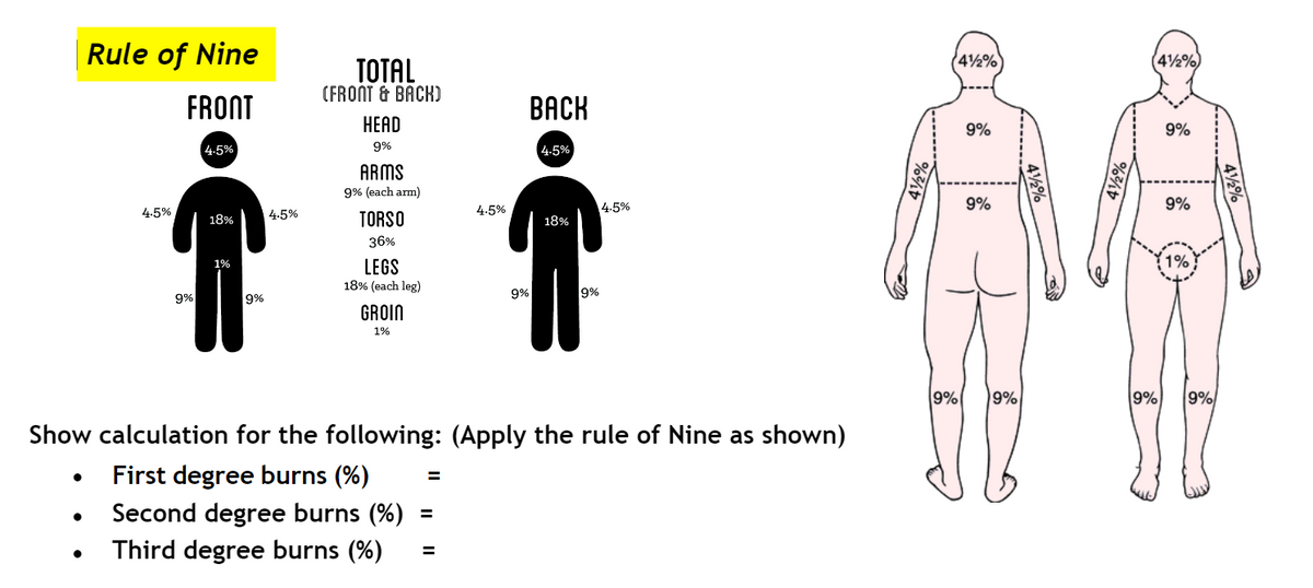 Rule of Nine
42%
42%)
TOTAL
(FRONT & BACK)
FRONT
ВАСK
НEAD
9%
9%
4.5%
9%
4.5%
ARMS
9% (each arm)
4.5%
9%
9%
4.5%
4.5%
TORSO
4.5%
18%
18%
36%
1%
LEGS
18% (each leg)
1%
9%
9%
9%
9%
GROIN
1%
9%
9%
9%
9%
Show calculation for the following: (Apply the rule of Nine as shown)
First degree burns (%)
Second degree burns (%)
Third degree burns (%)
42%
42%
