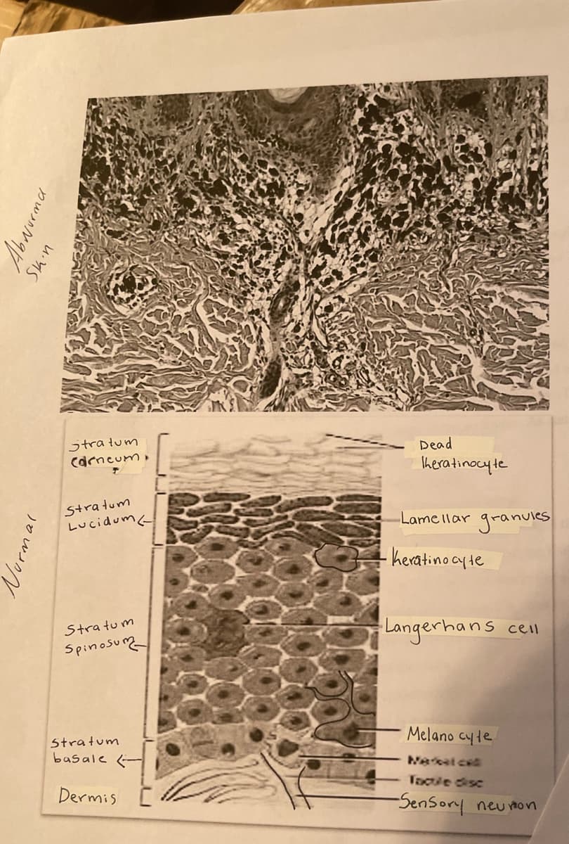 Abnorma
Skin
Normal.
Stratum
Carneum,
Stratum
Lucidum
Stratum
Spinosum
Stratum
basale
Dermis
Dead
Theratinocyte
-Lamellar granules
·Keratinocyte
Langerhans
Melanocyte
cell
Tacule disc
-Sensory neumon