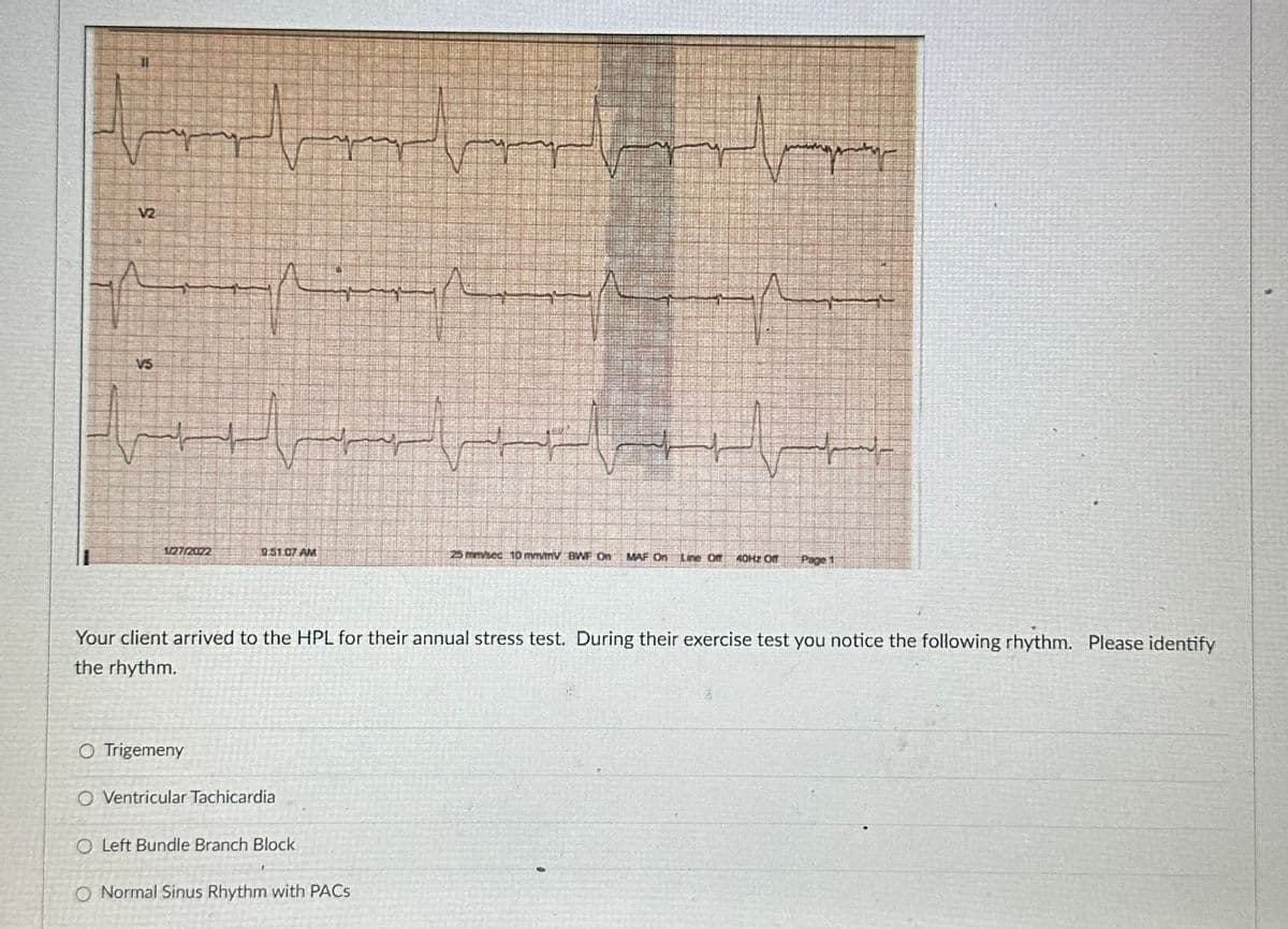 V2
1/27/2072
O Trigemeny
بنم
helme
05107 AM
O Ventricular Tachicardia
O Left Bundle Branch Block
1
m
الله
Your client arrived to the HPL for their annual stress test. During their exercise test you notice the following rhythm. Please identify
the rhythm.
O Normal Sinus Rhythm with PACs
23 mmke: 10 mmmy BWF OF MAF On
H
40H2 Of