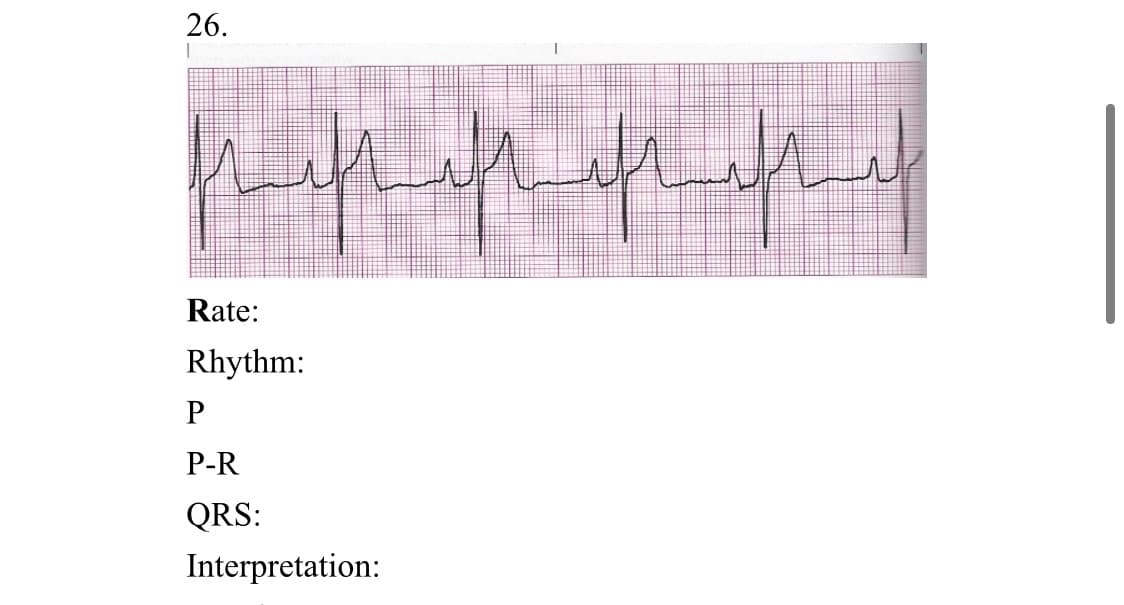 26.
Rate:
Rhythm:
P-R
QRS:
Interpretation:
