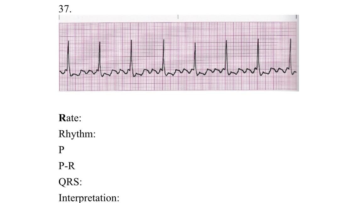 37.
Rate:
Rhythm:
P-R
QRS:
Interpretation:
