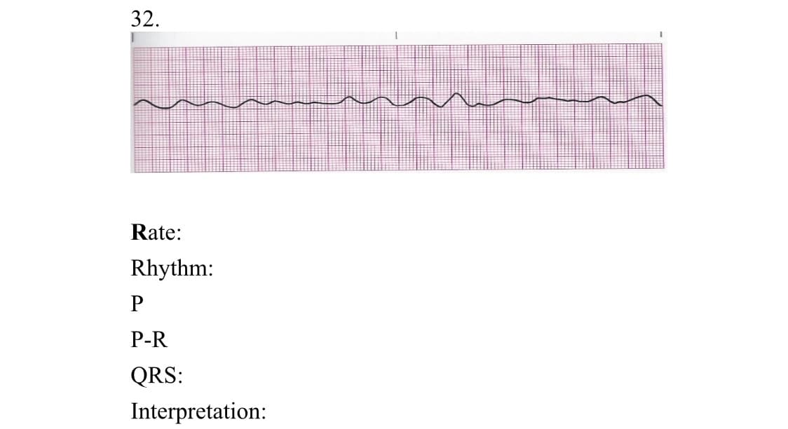 32.
Rate:
Rhythm:
P-R
QRS:
Interpretation:
