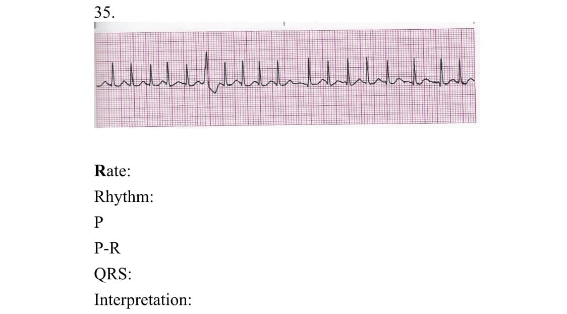 35.
Rate:
Rhythm:
P-R
QRS:
Interpretation:
