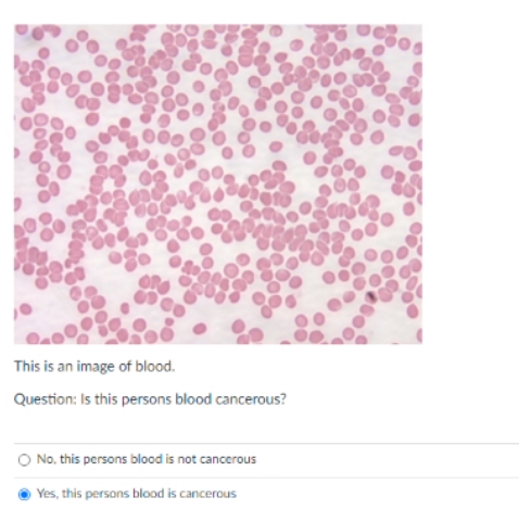 This is an image of blood.
Question: Is this persons blood cancerous?
O No, this persons blood is not cancerous
Yes, this persons blood is cancerous
