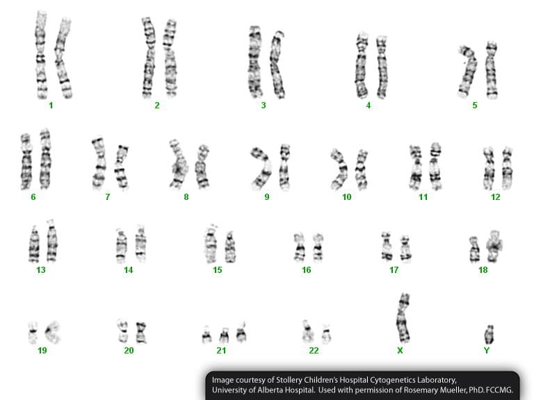 17
18
19
22
Image courtesy of Stollery Children's Hospital Cytogenetics Laboratory,
University of Alberta Hospital. Used with permission of Rosemary Mueller, PhD. FCCMG.
20
