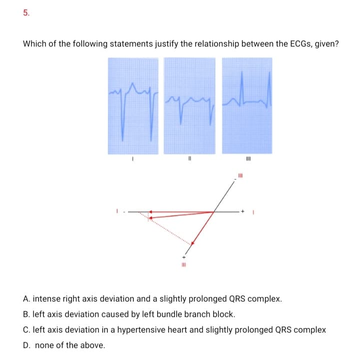 5.
Which of the following statements justify the relationship between the ECGS, given?
II
A. intense right axis deviation and a slightly prolonged QRS complex.
B. left axis deviation caused by left bundle branch block.
C. left axis deviation in a hypertensive heart and slightly prolonged QRS complex
D. none of the above.
