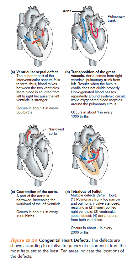 Aorta
-Pulmonary
trunk
(a) Ventricular septal defect.
The superior part of the
interventricular septum fails
to form; thus, blood mixes
between the two ventricles.
(b) Transposition of the great
vessels. Aorta comes from right
ventricle; pulmonary trunk from
left. Results when the bulbus
cordis does not divide properly.
Unoxygenated blood passes
repeatedly around systemic circuit,
while oxygenated blood recycles
around the pulmonary circuit.
More blood is shunted from
left to right because the left
ventricle is stronger.
Occurs in about 1 in every
500 births
Occurs in about 1 in every
1000 births
- Narrowed
aorta
(d) Tetralogy of Fallot.
Multiple defects (tetra = four):
(1) Pulmonary trunk too narrow
and pulmonary valve stenosed,
resulting in (2) hypertrophied
right ventricle; (3) ventricular
septal defect; (4) aorta opens
from both ventricles.
(c) Coarctation of the aorta.
A part of the aorta is
narrowed, increasing the
workload of the left ventricle.
Ocurs in about 1 in every
1500 births
Occurs in about 1 in every
2000 births
Figure 19.18 Congenital Heart Defects. The defects are
shown according to relative frequency of occurrence, from the
most frequent to the least. Tan areas indicate the locations of
the defects.
