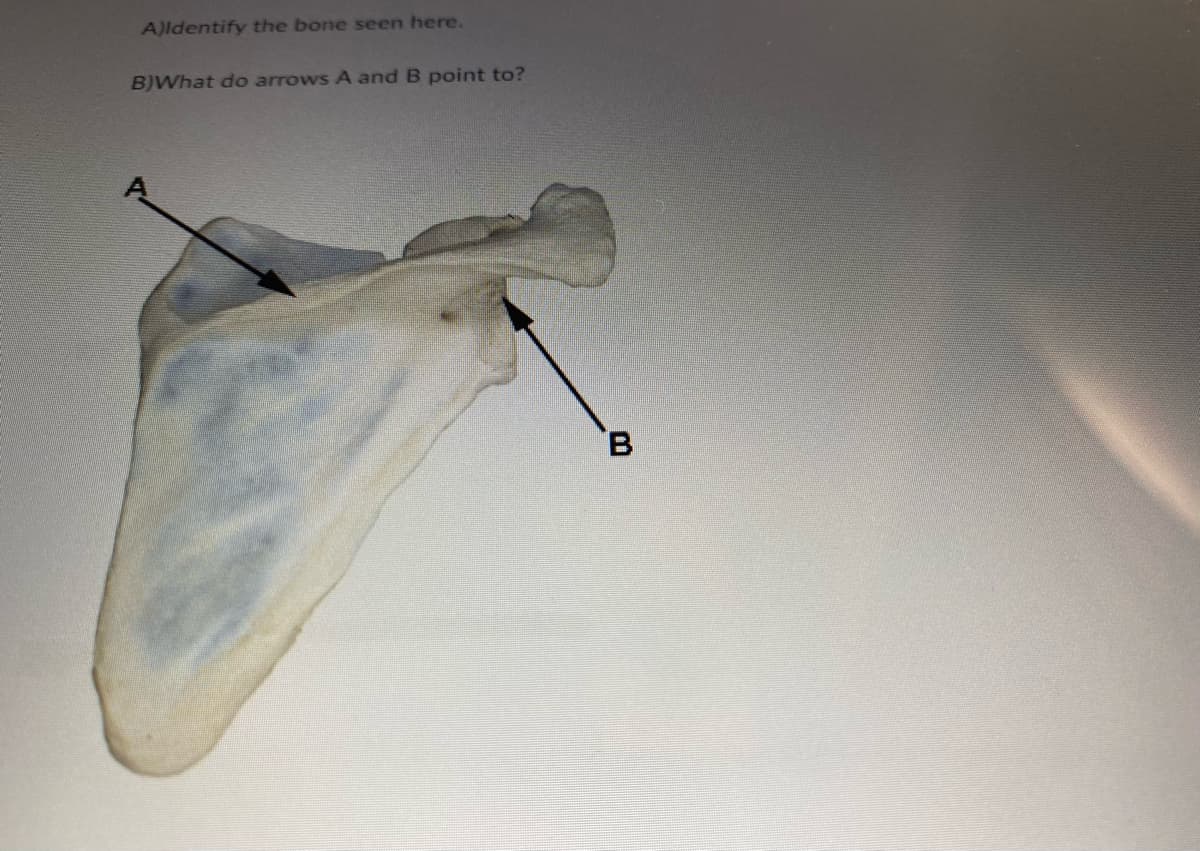 **Title: Identification of the Scapula and Its Key Anatomical Features**

---

**A) Identify the bone seen here.**

The bone shown in the image is the scapula, also known as the shoulder blade.

**B) What do arrows A and B point to?**

- Arrow **A**: Points to the **spine of the scapula**. This is a prominent ridge of bone that runs across the posterior surface of the scapula. It serves as an attachment point for muscles such as the trapezius and deltoid.
  
- Arrow **B**: Points to the **acromion**. The acromion is an extension of the scapular spine that forms the highest point of the shoulder. It articulates with the clavicle to form the acromioclavicular joint and serves as an attachment point for muscles.

---

In the image provided, we observe the posterior view of the scapula, highlighting the spine and the acromion. Understanding these features is essential for comprehending shoulder mechanics and identifying sites of muscle attachment crucial for upper limb movement.