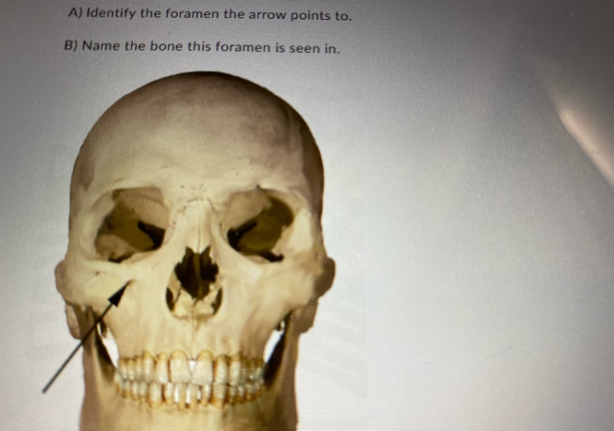 A) Identify the foramen the arrow points to.
B) Name the bone this foramen is seen in.
T