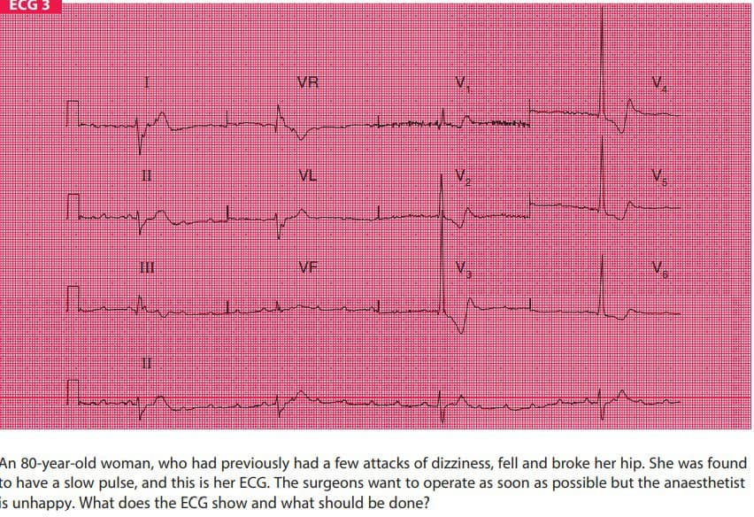 ECG 3
VR
V.
VL
V,
V.
VF
An 80-year-old woman, who had previously had a few attacks of dizziness, fell and broke her hip. She was found
to have a slow pulse, and this is her ECG. The surgeons want to operate as soon as possible but the anaesthetist
is unhappy. What does the ECG show and what should be done?
