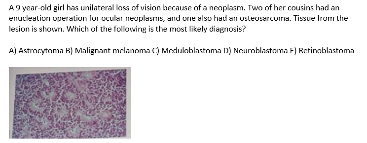 A 9 year-old girl has unilateral loss of vision because of a neoplasm. Two of her cousins had an
enucleation operation for ocular neoplasms, and one also had an osteosarcoma. Tissue from the
lesion is shown. Which of the following is the most likely diagnosis?
A) Astrocytoma B) Malignant melanoma C) Meduloblastoma D) Neuroblastoma E) Retinoblastoma
