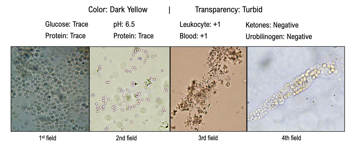 Color: Dark Yellow
|
Transparency: Turbid
Glucose: Trace
pH: 6.5
Leukocyte: +1
Ketones: Negative
Protein: Trace
Protein: Trace
Blood: +1
Urobilinogen: Negative
8.
8.
1st field
2nd field
3rd field
4th field
