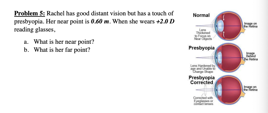 Problem 5: Rachel has good distant vision but has a touch of
presbyopia. Her near point is 0.60 m. When she wears +2.0 D
reading glasses,
a. What is her near point?
b. What is her far point?
Normal
Lens
Thickened
to Focus on
Near Objects
Presbyopia
Lens Hardened by
age and Unable to
Change Shape
Presbyopia
Corrected
Corrected with
Eyeglasses or
contact lenses
Image on
the Retina
Image
Behind
the Retina
Image on
the Retina