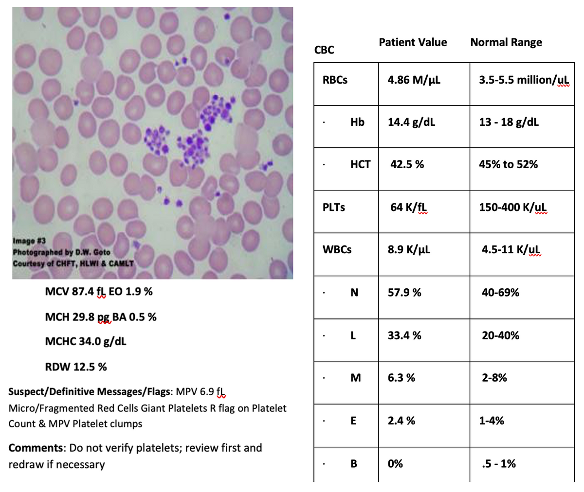 Patient Value
Normal Range
СВС
RBCS
4.86 M/µL
3.5-5.5 million/uL
Hb
14.4 g/dL
13 - 18 g/dL
HCT
42.5 %
45% to 52%
PLTS
64 K/fL
150-400 K/ul
Image #3
Photographed by D.W. Goto
Courtesy of CHFT, HLWI & CAMLT
WBCS
8.9 K/µl
4.5-11 К/uL
MCV 87.4 fL EO 1.9 %
N
57.9 %
40-69%
МCН 29.8 рg ВА 0.5%
33.4 %
20-40%
МСНС 34.0 g/dL
RDW 12.5 %
M
6.3 %
2-8%
Suspect/Definitive Messages/Flags: MPV 6.9 fl
Micro/Fragmented Red Cells Giant Platelets R flag on Platelet
Count & MPV Platelet clumps
E
2.4 %
1-4%
Comments: Do not verify platelets; review first and
redraw if necessary
0%
.5 - 1%
