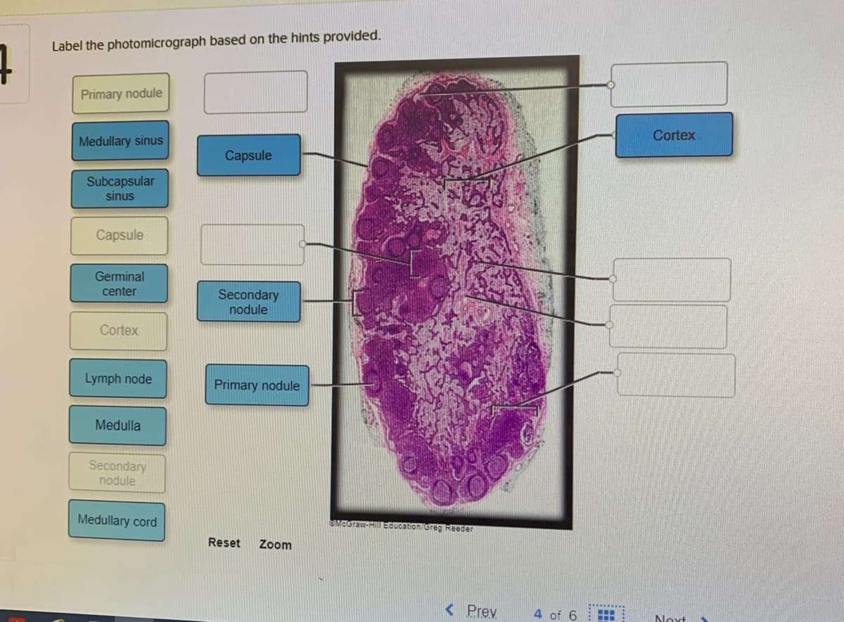 4
Label the photomicrograph based on the hints provided.
Primary nodule
Medullary sinus
Capsule
Subcapsular
sinus
Capsule
Germinal
center
Secondary
nodule
Cortex
Lymph node
Primary nodule
Medulla
Secondary
nodule
Medullary cord
Reset Zoom
McGraw-Hill Education/Greg Reeder
< Prev
4 of 6
www
Cortex
Next