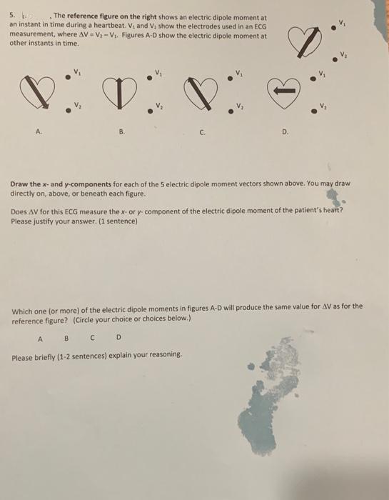5. The reference figure on the right shows an electric dipole moment at
an instant in time during a heartbeat. Vi and V, show the electrodes used in an ECG
measurement, where AV = V - V. Figures A-D show the electric dipole moment at
other instants in time.
B.
C.
D.
Draw the x- and y-components for each of the 5 electric dipole moment vectors shown above. You may draw
directly on, above, or beneath each figure.
Does AV for this ECG measure the x- or y- component of the electric dipole moment of the patient's heart?
Please justify your answer. (1 sentence)
Which one (or more) of the electric dipole moments in figures A-D will produce the same value for AV as for the
reference figure? (Circle your choice or choices below.)
A B CD
Please briefly (1-2 sentences) explain your reasoning.
