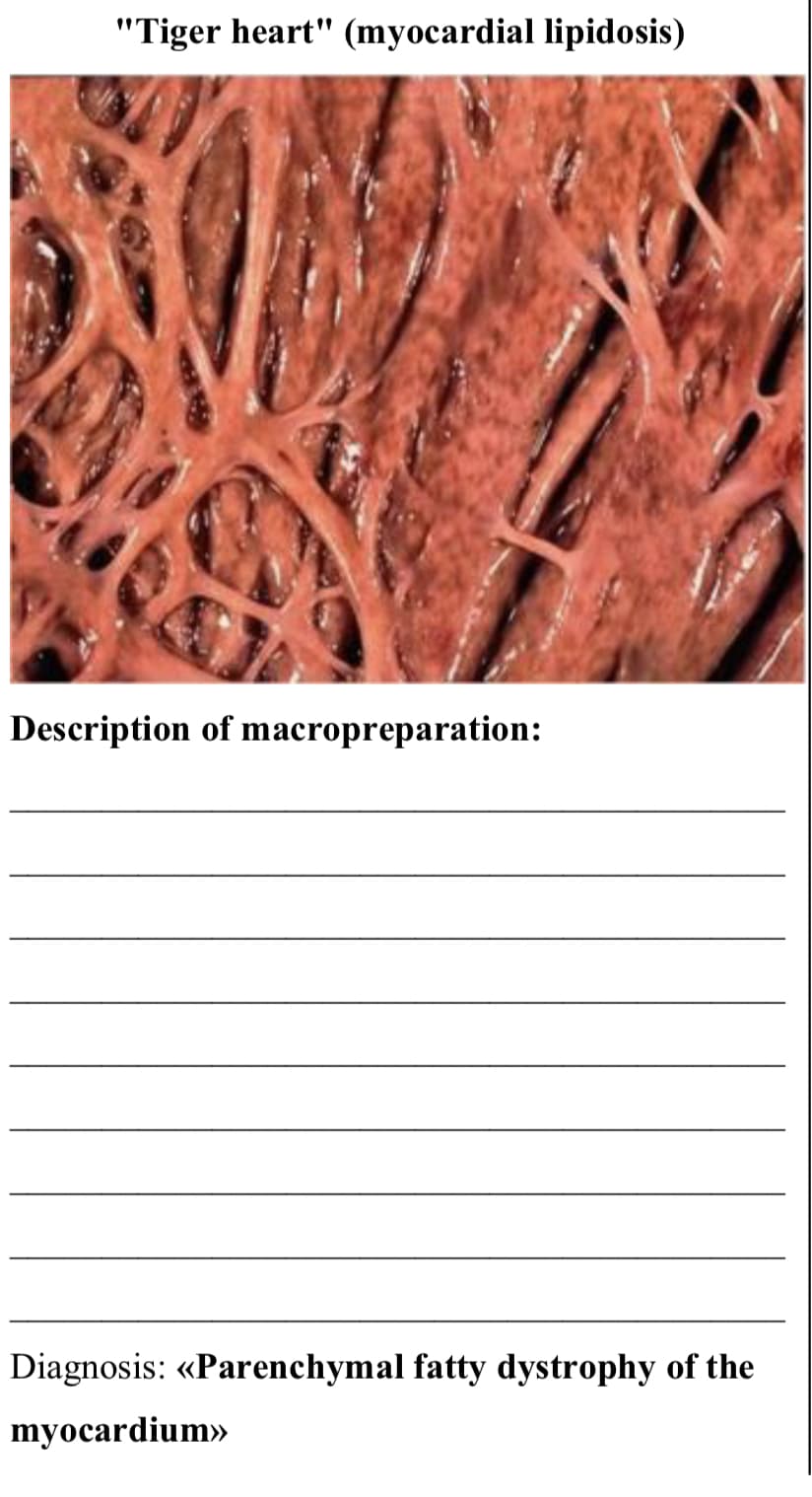 "Tiger heart" (myocardial lipidosis)
Description of macropreparation:
Diagnosis: <<Parenchymal fatty dystrophy of the
myocardium>>