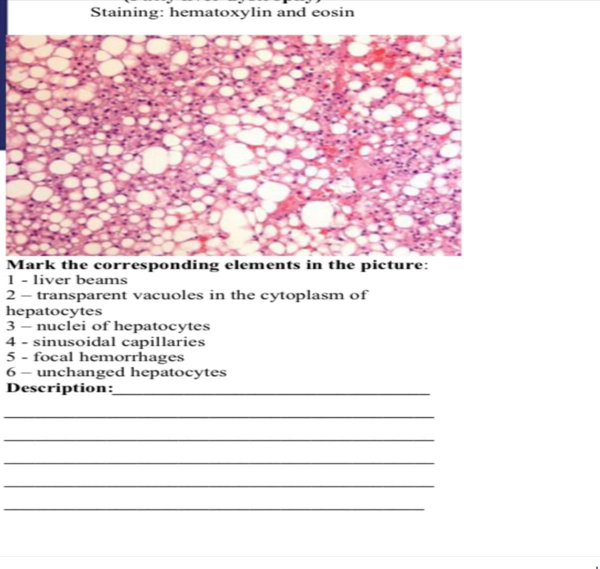 Staining: hematoxylin and eosin
Mark the corresponding elements in the picture:
1 - liver beams
2- transparent vacuoles in the cytoplasm of
hepatocytes
3- nuclei of hepatocytes
4-sinusoidal capillaries
5 - focal hemorrhages
6 - unchanged hepatocytes
Description: