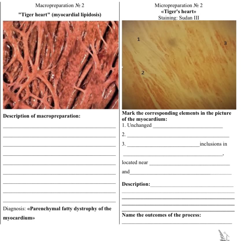 Macropreparation №o 2
"Tiger heart" (myocardial lipidosis)
Description of macropreparation:
Diagnosis: <<Parenchymal fatty dystrophy of the
myocardium»>
1
2
located near
and
Micropreparation №o 2
<<Tiger's heart»
Staining: Sudan III
Mark the corresponding elements in the picture
of the myocardium:
1. Unchanged
2.
3.
Description:
3
inclusions in
Name the outcomes of the process: