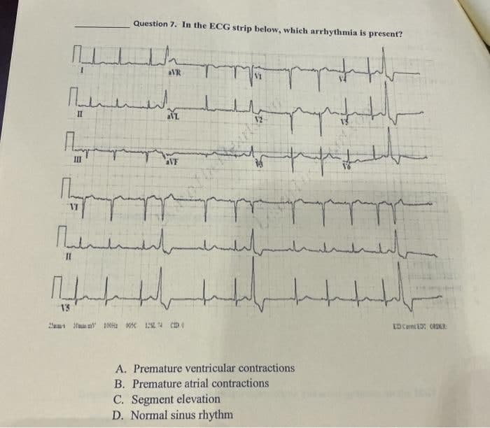 Question 7. In the ECG strip below, which arrhythmia is present?
aVR
II
II
13
EDCent ED CRDER:
A. Premature ventricular contractions
B. Premature atrial contractions
C. Segment elevation
D. Normal sinus rhythm
