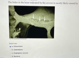 The holes in the bone indicated by the arrows in mostly likely caused by
Selecet one
Duteolanta
b. Oseoblaste
e Angiogenic vessels
d. Bacteria
