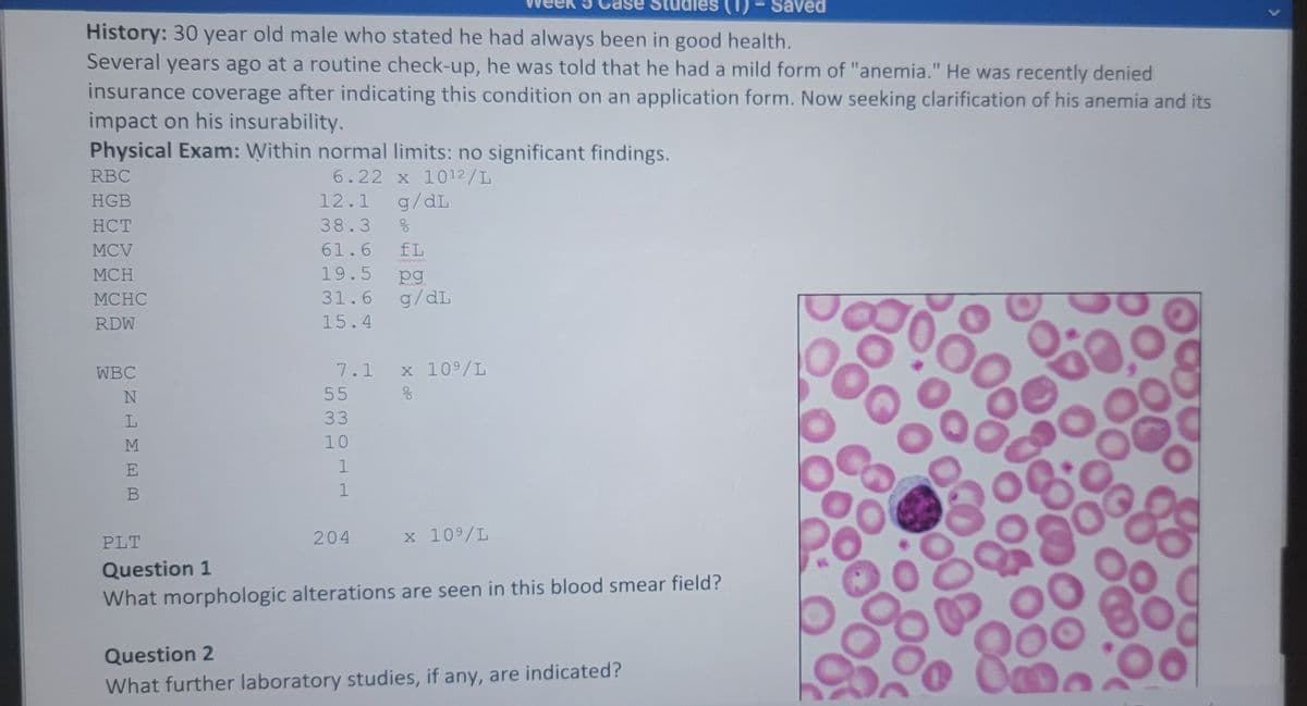 History: 30 year old male who stated he had always been in good health.
Several years ago at a routine check-up, he was told that he had a mild form of "anemia." He was recently denied
insurance coverage after indicating this condition on an application form. Now seeking clarification of his anemia and its
impact on his insurability.
Physical Exam: Within normal limits: no significant findings.
6.22 x 1012/L
RBC
HGB
HCT
MCV
MCH
MCHC
RDW
WBC
ΖΗΣΕ Μ
N
L
M
E
B
12.1 g/dL
38.3 %
61.6 fL
19.5 pg
31.6
15.4
7.1
55
33
10
531
1
1
204
g/dL
x 10⁹/L
응
x 10⁹/L
PLT
Question 1
What morphologic alterations are seen in this blood smear field?
Saved
Question 2
What further laboratory studies, if any, are indicated?
O
<