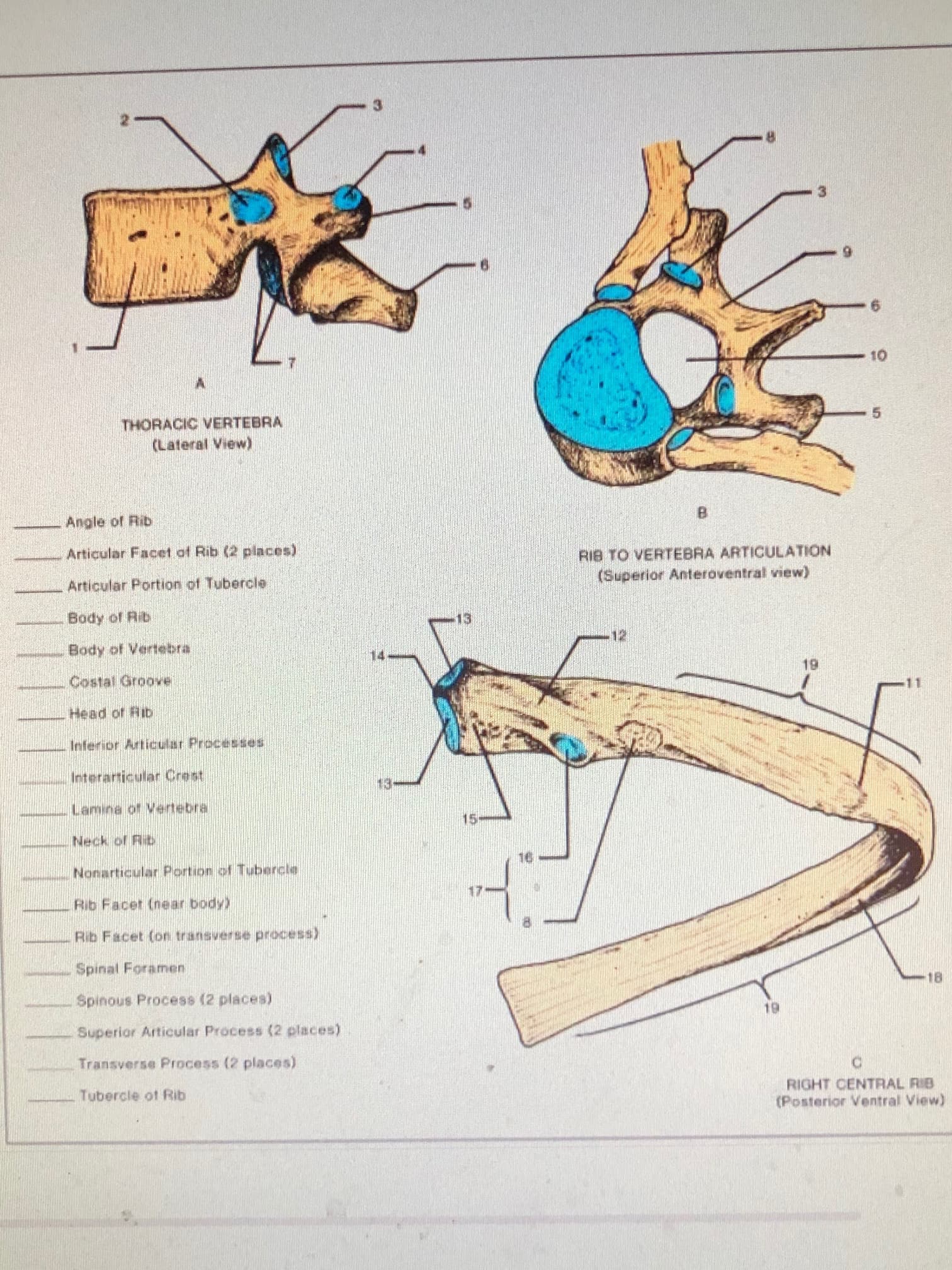 THORACIC VERTEBRA
(Lateral View)
5.
Angle of Rib
B.
Articular Facet of Rib (2 places)
RIB TO VERTEBRA ARTICULATION
(Superior Anteroventral view)
Articular Portion of Tubercle
Body of Rib
13
Body of Vertebra
12
14
Costal Groove
Head of Rib
Inferior Articular Processes
Interarticular Crest
Lamina of Vertebra
Neck of Rib
5-
Nonarticular Portion of Tubercle
Rib Facet (near body)
17
Rib Facet (on transverse process)
Spinal Foramen
Spinous Process (2 places)
Superior Articular Process (2 places)
Transverse Process (2 places)
RIGHT CENTRAL RIB
(Posterior Ventral View)
Tubercle of Rib
